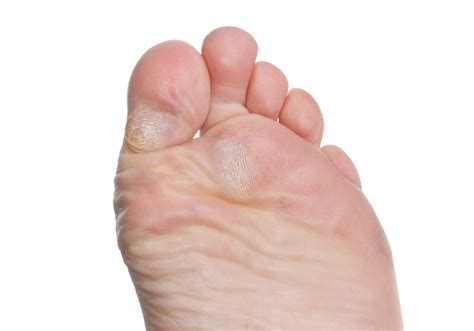 Corns Vs Calluses Symptoms And Treatments Red Mountain Footcare