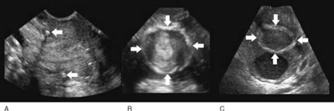 Ultrasound Evaluation Of The Cervix Radiology Key Ultrasound Sonography Ultrasound Cervix