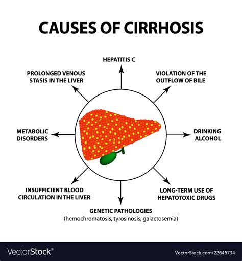 Causes Of Cirrhosis Infographics Royalty Free Vector Image