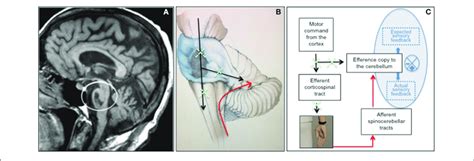 Ventral Brainstem Lesion In The Locked In Syndrome As Shown By Mri