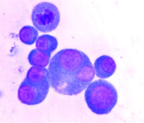 Pleural Fluid Cytology Many Atypical Plasma Cells With Open I
