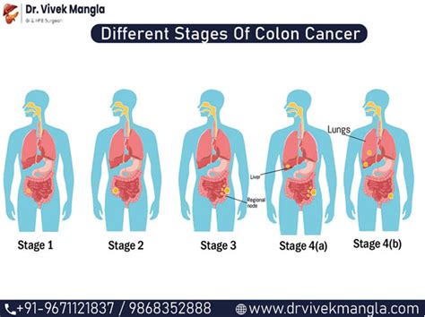 Different Stages Of Colon Cancer