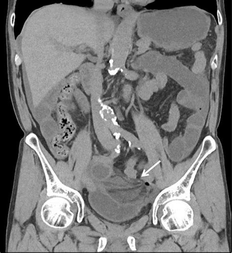 Coronal Image Of Non Contrast Computed Tomography Showed Thickened