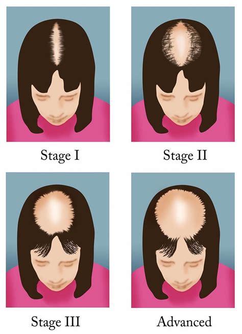 How To Fix Female Pattern Hair Loss Tips Faqs And Hair Care Best Simple Hairstyles For Every
