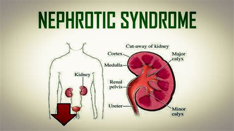 What Is Nephrotic Syndrome Signs And Symptoms Causes Diagnosis And