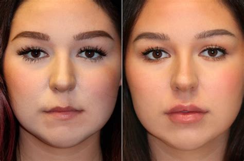 Lip Augmentation Photos Chevy Chase Md Patient 15105