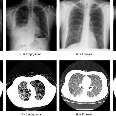Examples Images Of Nih Chest X‐ray After Preprocessing And Augmentation