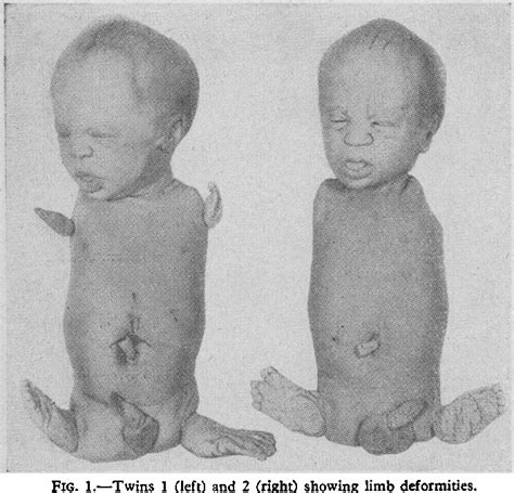 Figure 1 From 524 2 December 1967 Congenital Phocomelia In Monozygotic