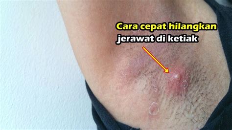 Cara menghilangkan jerawat batu dan bekasnya ini sangat mudah. 4 Cara Cepat Hilangkan Jerawat di Ketiak - YouTube