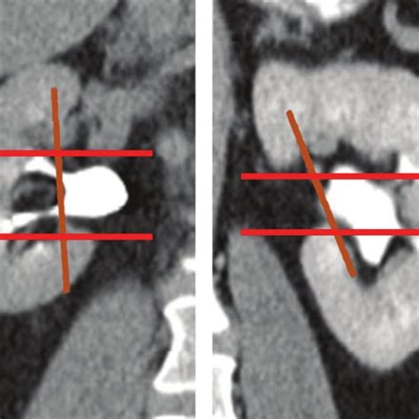 Contrast Enhanced Coronal Ct Scans Of The Kidney In The Delayed Phase