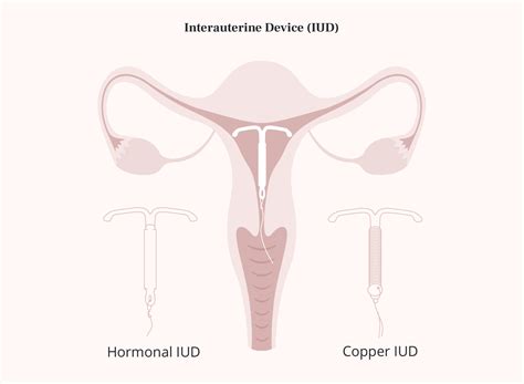 Copper Iud What Are The Pros And Cons Healthnews