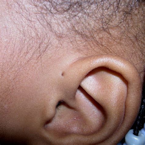 Reason For Tiny Hole Above The Ear Finally Explained