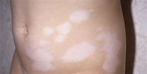 Pediatric Vitiligo Look Beyond The Skin For Complete