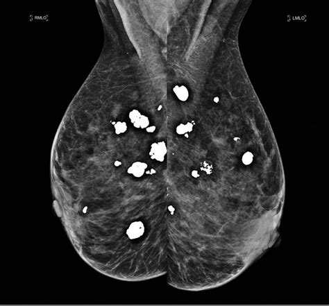 Breast Calcifications Mimicking Pulmonary Nodules Cleveland Clinic