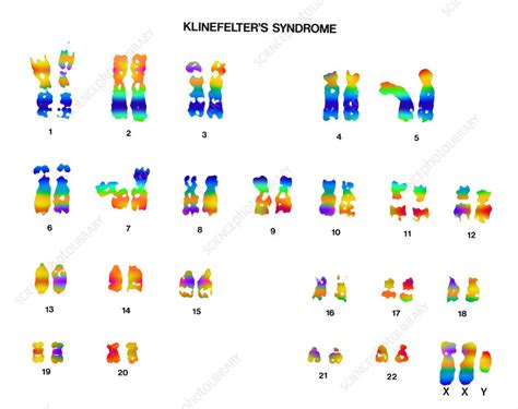 Klinefelters Syndrome Karyotype Stock Image C0220583 Science Photo Library