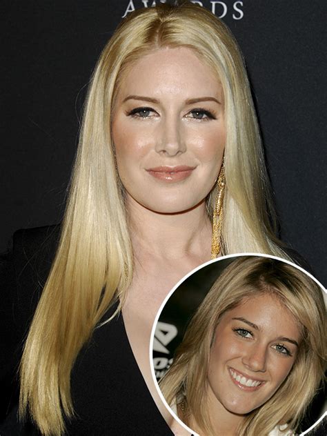 Heidi Montag Almost Died During Plastic Surgery See Her Transformation