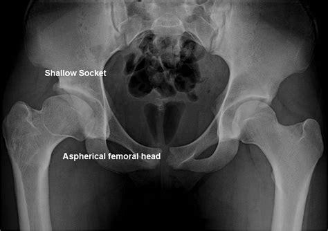 Perthes Disease St Louis Mo Open Hip Dislocation Washington
