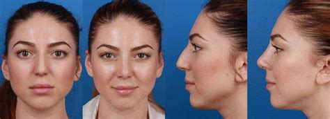 Cosmetic Surgeons New York City Gotham Plastic Surgery