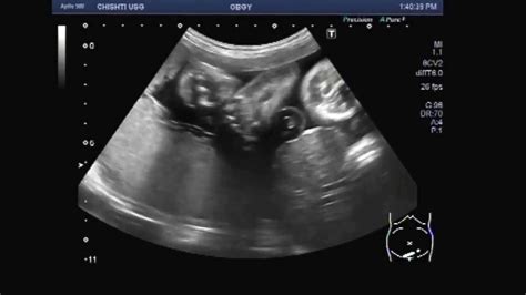 Ultrasound Video Showing A Rare Case Of Fetal Anomaly Called
