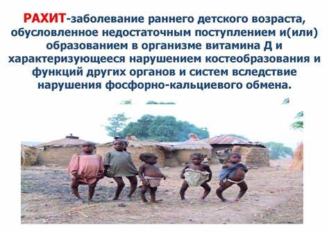 Гипервитаминоз д диета Рахит_Спазмофилия_Гипервитаминоз_Д_ - презентация онлайн Рахит_Спазмофилия_Гипервитаминоз_Д_ - презентация онлайн Гипервитаминоз д диета