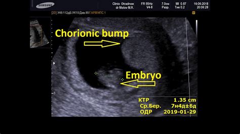 Chorionic Bump хорионическая шишка УЗИ беременности Youtube