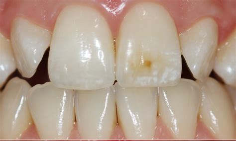 Brown Spots On Teeth Renew Physical Therapy