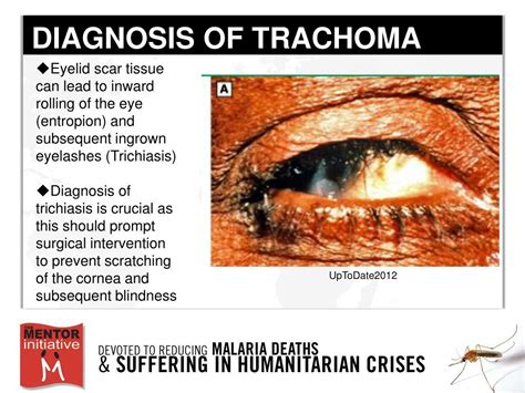 Ppt Trachoma Diagnosis Treatment And Prevention Melina Lopez