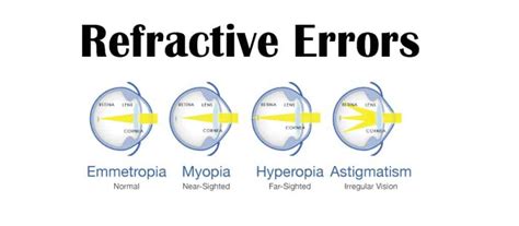 Refractive Errors Types Symptoms And Treatment Sight Care Sight