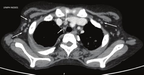 Ct Scan Of The Chest Showing Hilar And Axillary Lymphadenopathy Arrows
