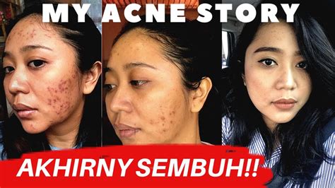 Jun 07, 2021 · bila ingin hasil yang lebih maksimal untuk mengatasi jerawat bernanah, konsultasikan dengan ahli agar penanganan tepat bisa didapatkan. CARA MENYEMBUHKAN JERAWAT MERADANG (STEP PALING PENTING ...