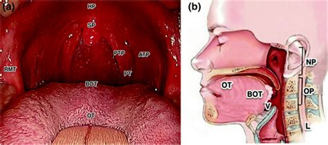 Clinical Presentation Of Hpv Driven Oropharyngeal Carcinoma Springerlink