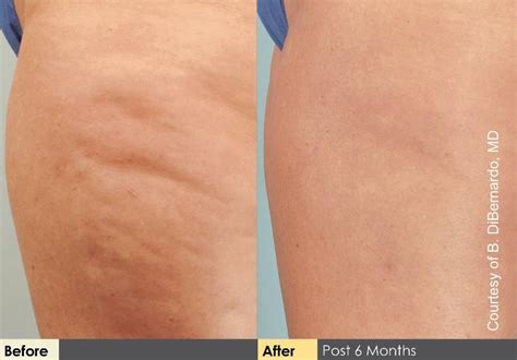 cellulaze laser cellulite removal treatment review