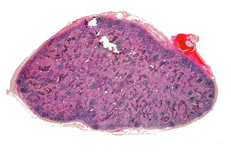 Inflamed Lymph Gland Photograph By Dr Keith Wheelerscience Photo Library