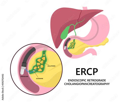 Plakat Choledocholithiasis Endoscopic Retrograde