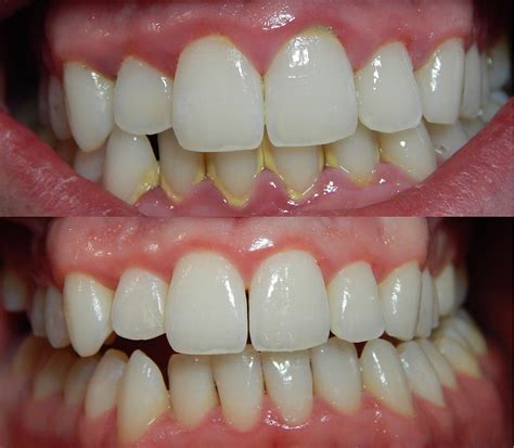 Signs Of Gingivitis Gingivitis Causes Gingivitis Treatment And Cures