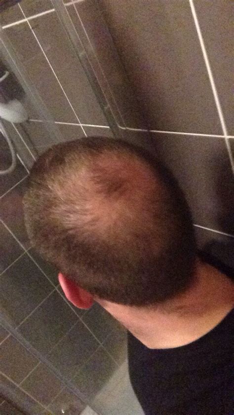 Regrow thinning hair with these 5 effective methods. 24, thinking of buzzing short as balding on crown and up ...