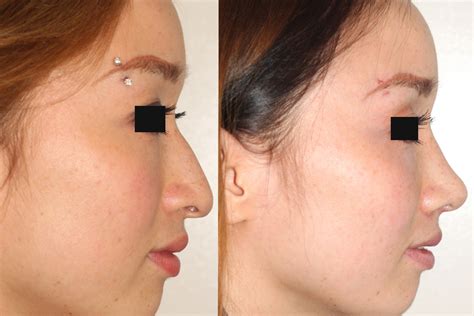 The Basic Facts About Rhinoplasty And Nose Reshaping Surgery