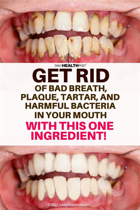 Get Rid Of Bad Breath Plaque Tartar And Harmful Bacteria In Your
