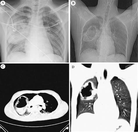 Image In Chest X Ray Cxr Film And Computed Tomography Ct Scan A