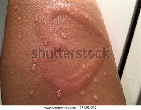 Skin Writing Dermographism Stock Photo Edit Now 1151352239