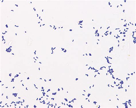 Severe Cavitary Pneumonia Caused By A Non Equi Rhodococcus Species In