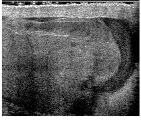Ruptured Testis With Hematocele Ultrasound Image Of The Right Testis