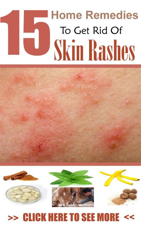 Famous How To Get Rid Of Dog Hives Home Remedies References