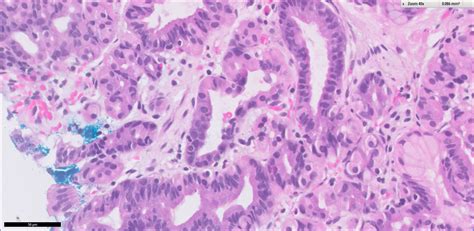 Pathology Outlines Fundic Gland Polyp