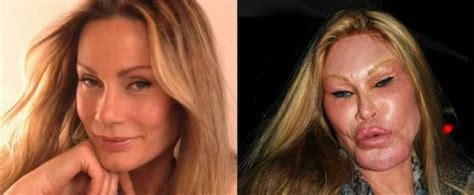 21 Celebrities With Botched Plastic Surgery Eww Gallery Ebaum S World