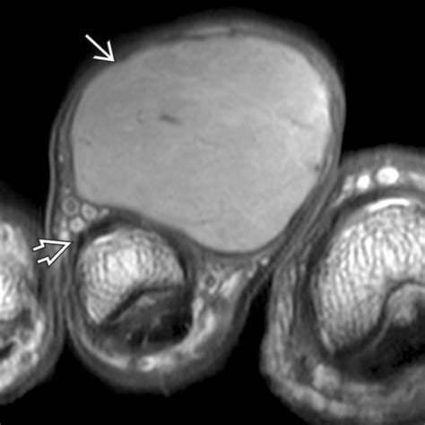 Dermatofibrosarcoma Protuberans Radiology Key