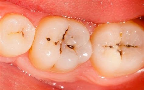 How Are Cavities Treat Edmonton Downtown Dentist
