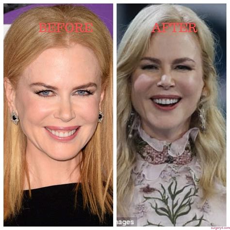 Nicole Kidman Plastic Surgery Photos Before And After Surgery4