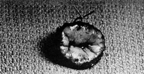 3 the sturmdorf suture is obsolete. Lasers in Gynecology | GLOWM
