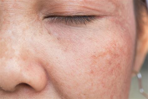 How To Get Rid Of Red Spots On The Face Garcia Institute